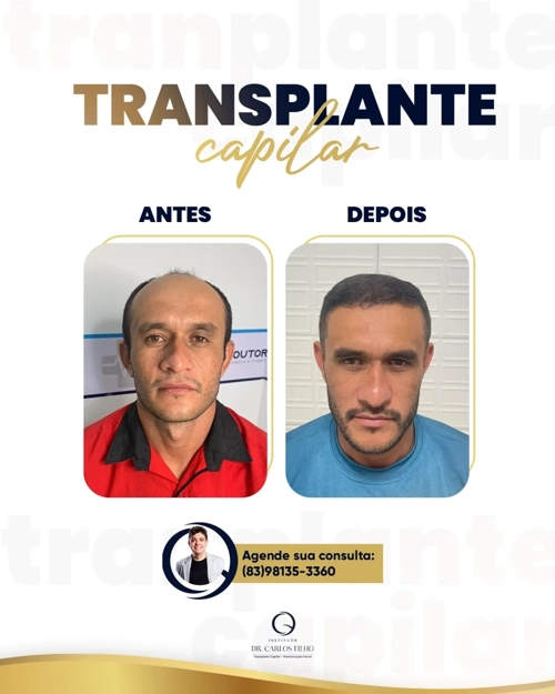 Transplante Capilar