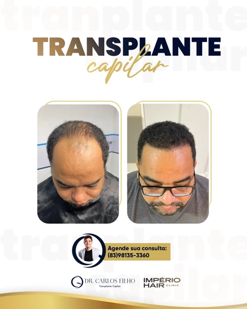 Transplante Capilar