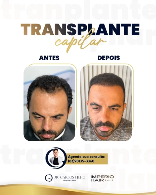 Transplante Capilar