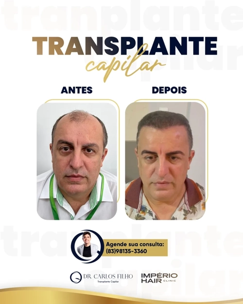 Transplante Capilar