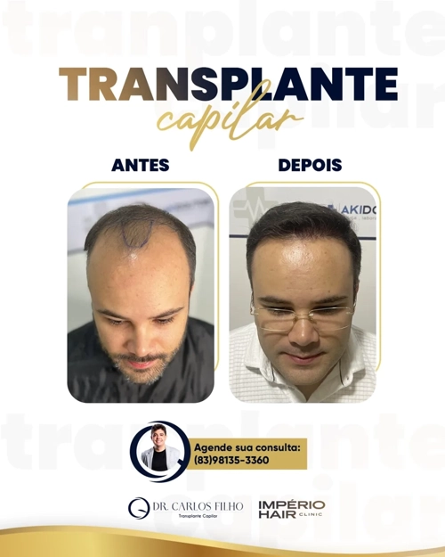 Transplante Capilar