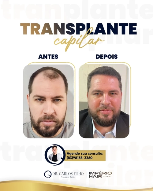 Transplante Capilar