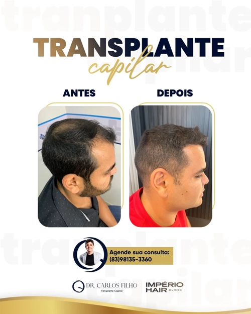 Transplante Capilar