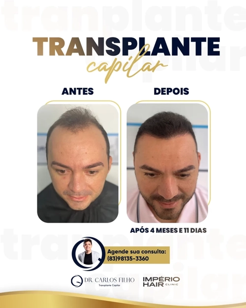 Transplante Capilar