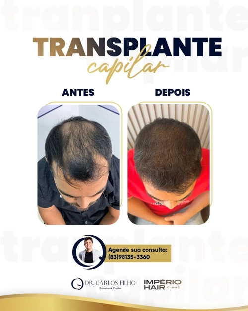 Transplante Capilar