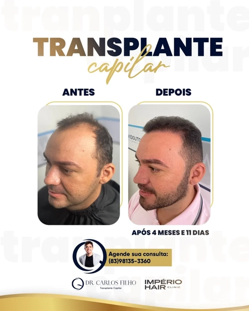 Transplante Capilar