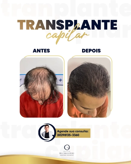 Transplante Capilar