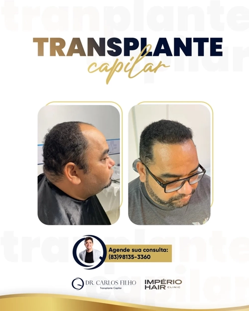 Transplante Capilar