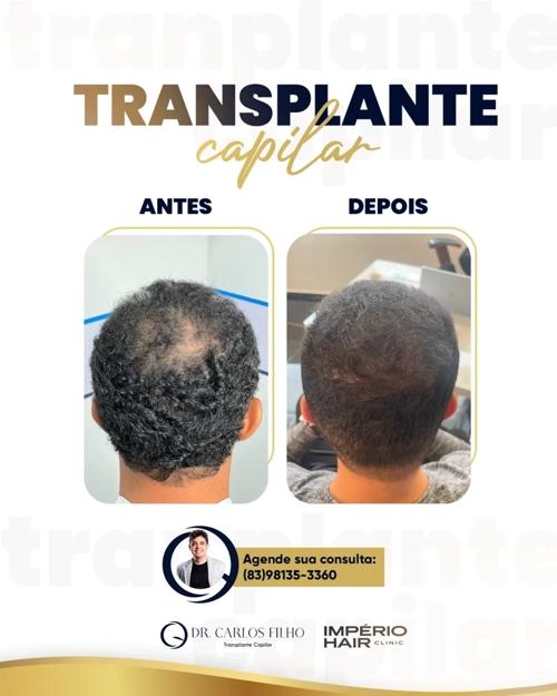 Transplante Capilar