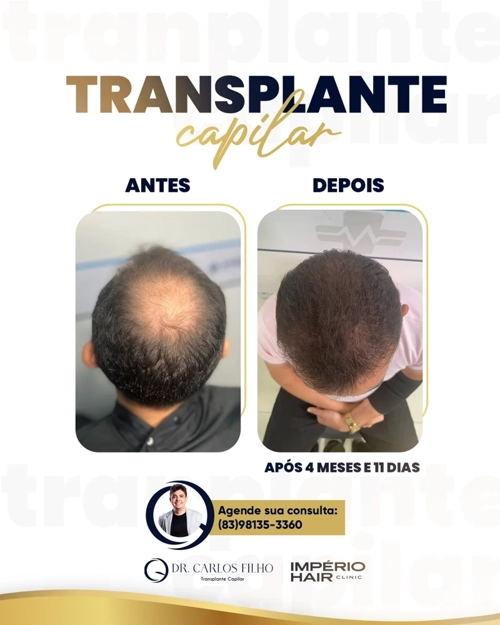 Transplante Capilar